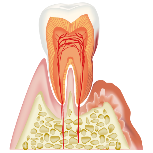 中等度歯周病のイラスト画像