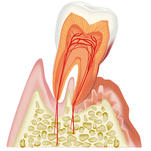 重度歯周病のイラスト画像