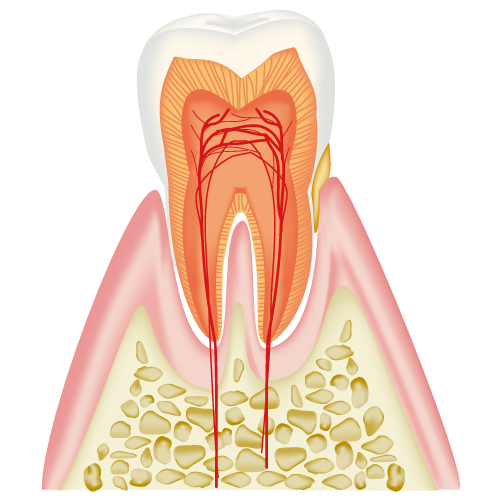 軽度歯周病のイラスト画像