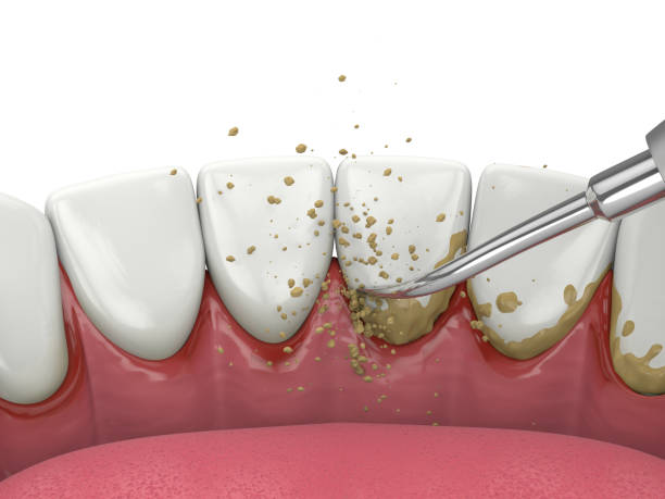 歯石除去のイラスト画像