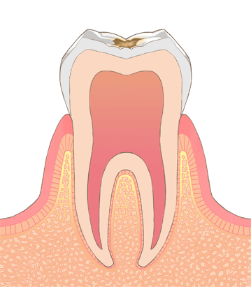 C2の歯のイラスト