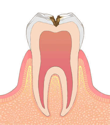 C3の歯のイラスト